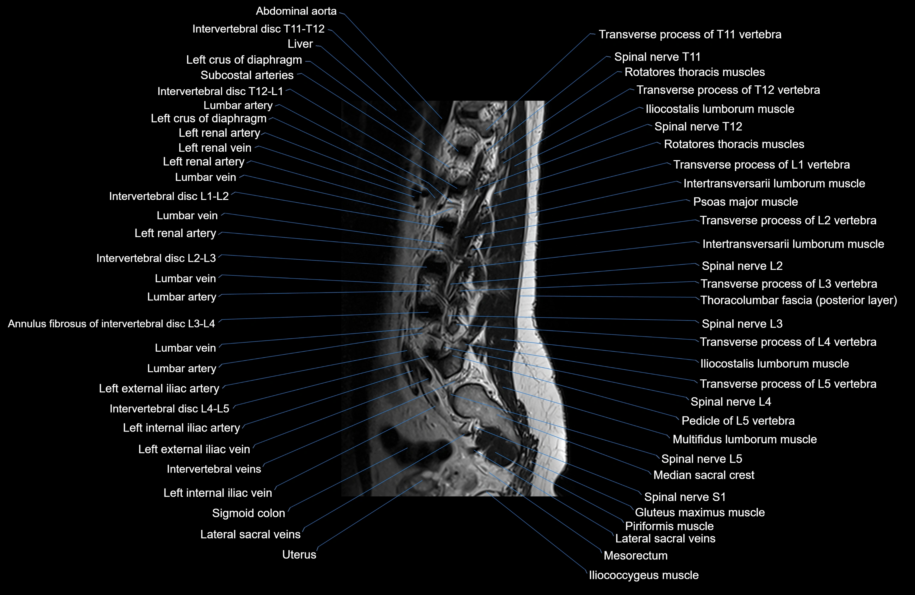 MRI lumbar spine sagittal cross sectional anatomy 3T radiology  image-img-00001-00022.webp